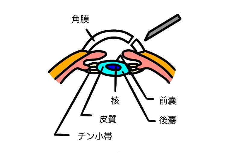 水晶体前嚢の切開