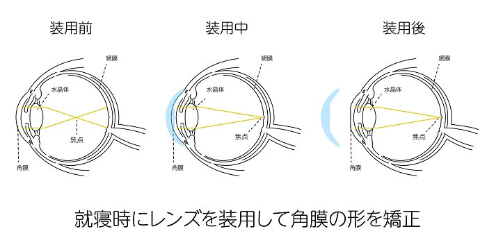オルソケラトロジーとは