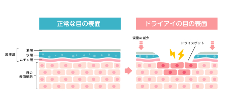 ドライアイとは