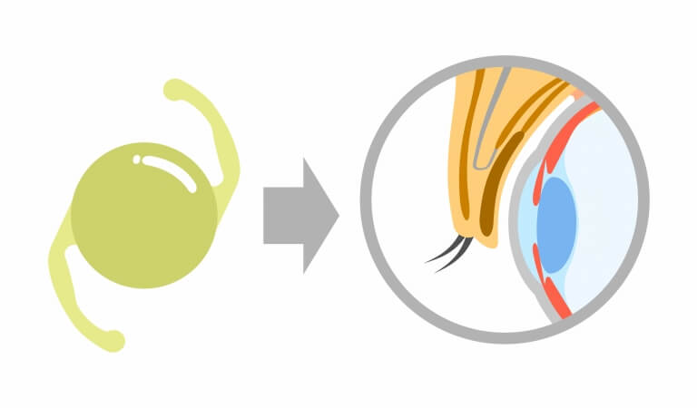多焦点眼内レンズとは