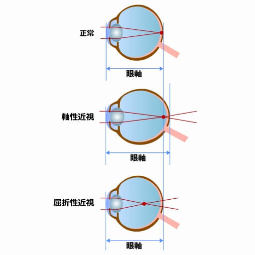 近視とは？ わかりやすく解説