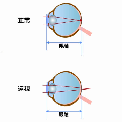 遠視 大人 に なっ て から