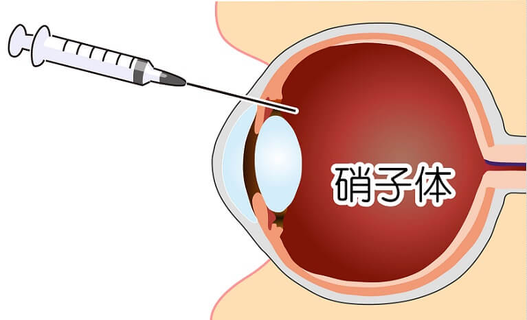 硝子体注射（抗VEGF療法）の効果とは