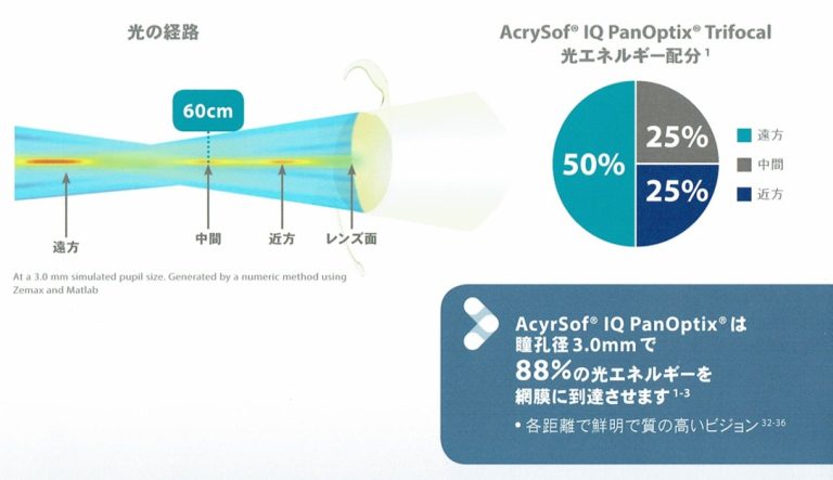 クラレオン・パンオプティクスは<br />乱視矯正も可能
